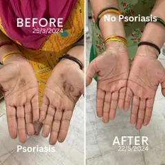 This is why I do what I do. This is my own mother's hand, before and after two months of following a Yogic and Ayurvedic lifestyle I designed for her. She suffered from Psoriasis for years with no relief from modern medicine, but with consistent, natural practice, we healed it completely. This is the power of real yoga.