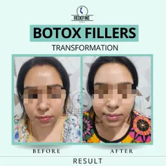 This client was looking for overall facial rejuvenation. By using a combination of Botox and dermal fillers, I was able to soften lines and restore volume, resulting in a fresher, more rested appearance. This is a perfect example of a non-surgical transformation.