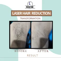 Say goodbye to razors and hello to carefree confidence. This before and after of an underarm laser treatment shows how you can achieve permanently smooth skin in just a few sessions.