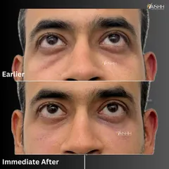 Under-eye hollows can make you look tired regardless of how much you rest. With just 1 ml of hyaluronic acid filler, we were able to instantly correct the volume loss in the tear trough area, resulting in a brighter and more youthful look.