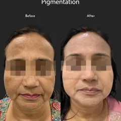 This before and after image focuses on treating pigmentation on the forehead and cheeks. The 'after' photo shows a significant reduction in hyperpigmentation, leading to a more uniform and youthful skin appearance.