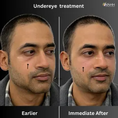 This side view shows the correction of under-eye bags. The filler smooths the transition between the cheek and the under-eye area, creating a seamless and youthful contour.
