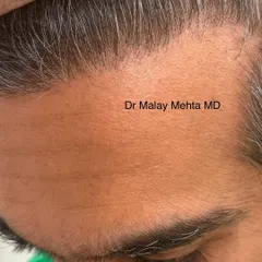 The secret to an undetectable hair transplant lies in the hairline. I never create harsh, straight lines. Instead, I design a soft, irregular hairline using a mix of single hair follicles, which perfectly mimics nature. This close-up shows the result of that artistic approach.