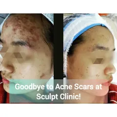 Here you can see a remarkable improvement in severe acne and subsequent scarring. Our personalized treatment plans target active acne to reduce inflammation and then focus on smoothing skin texture and fading scars for a clearer complexion.