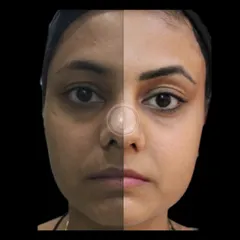 This is a clear, unannotated view of the same client's transformation. The left side is before any treatment, and the right side shows the result after a comprehensive skin journey that was completed with permanent eyebrow makeup for a defined, finished look.