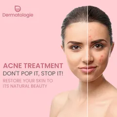 Don't pop it, stop it. The best way to treat acne and prevent scarring is to address it with a proper medical treatment plan that restores your skin's natural beauty.