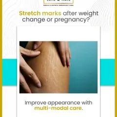 Stretch marks from pregnancy or weight changes are a common concern. I use a combination of advanced treatments, tailored to your specific skin needs, to significantly improve their appearance and restore your skin's texture.