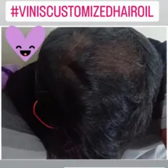 And this is the 'after' photo! With regular use of the customized hair oil I prepared for him, you can see the wonderful improvement in hair density. I am so thankful he shared his result with us.