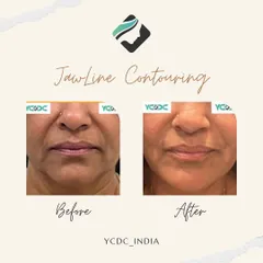 A frontal view of a jawline contouring procedure. Using hyaluronic acid fillers, I was able to soften the appearance of jowls and create a more defined lower face, resulting in a subtle lift.