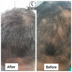 This before and after image shows the successful treatment of alopecia areata on the back of the head. The patchy hair loss has been completely resolved with full, healthy hair growth.