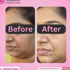 Pigmentation and uneven skin tone are very common concerns, but they don't have to be permanent. This before and after showcases the significant clearing of dark spots and melasma, resulting in a much brighter and more even complexion.
