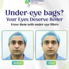Tired of looking exhausted even when you are not? Under-eye hollows and dark circles can be effectively treated with our precise, non-surgical filler treatments. We restore lost volume to give you a naturally refreshed and brighter appearance, helping you look as good as you feel.
