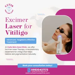 This image shows our Excimer Laser Therapy for vitiligo in action. This advanced, targeted treatment is a revolutionary way to help stimulate repigmentation and restore the skin’s natural tone safely and with visible results.