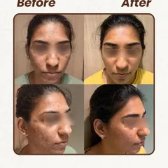 This patient was struggling with both acne and the dark marks it left behind. Our treatment plan targeted both issues simultaneously, using procedures that reduce pigmentation while preventing new breakouts. You can see how much the skin tone has evened out.