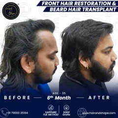 A side profile view showcasing the new, dense beard growth and restored hairline just 6 months after the combined procedure.