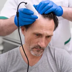 Before any procedure, a thorough scalp analysis is essential. I use tools like a trichoscope to examine your hair follicles and scalp health up close. This diagnostic step helps me determine the cause of hair loss and confirm if you are a suitable candidate for a transplant.