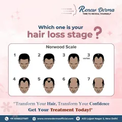 The Norwood Scale helps us identify the stage of male pattern baldness. Understanding where you are on this scale allows us to recommend the most effective treatment, as early intervention often yields the best results.