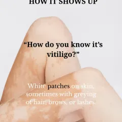 Vitiligo typically shows up as white patches on the skin and can sometimes be accompanied by the greying of hair, eyebrows, or eyelashes. Early and accurate diagnosis is important.