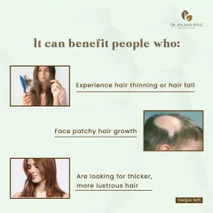 Hair Mesotherapy is beneficial for individuals experiencing hair thinning, patchy hair growth (alopecia areata), or those simply seeking thicker, more lustrous hair. It is a versatile tool in my hair restoration practice.