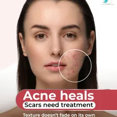 Many people believe acne marks will fade on their own, but this is a myth. While a pimple heals, the scar it leaves behind is a permanent change in skin texture that requires professional treatment. My approach is to assess the scar depth and your skin's healing capacity to create a strategy for real, lasting smoothness.