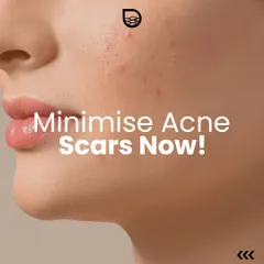 You can minimize the appearance of acne scars. A combination of professional treatments and the right at-home care can make a significant difference.