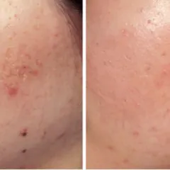 The transformation in this before and after image is a testament to the effectiveness of CO2 laser for severe acne scarring. The treatment helped to level the skin's surface and improve overall skin quality, leading to a significant confidence boost.
