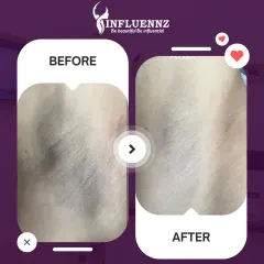 This before and after image shows a significant reduction in underarm pigmentation after a specialized brightening treatment. The skin appears visibly lighter, smoother, and more even-toned, helping restore confidence.