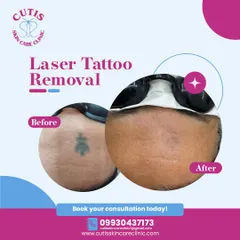 This is a clear example of a successful laser tattoo removal. Using advanced Q-switch laser technology, we were able to significantly fade this tattoo over several sessions, leaving the skin clear and demonstrating the effectiveness of our scar-minimized approach.