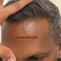 Even with graying hair, the principle remains the same. The hairline is soft, irregular, and looks completely natural. My goal is for people to notice your great hair, not your hair transplant.