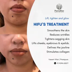 See the real-world benefits of my HIFU treatment. It effectively smoothens the skin, reduces wrinkles, tightens sagging areas, and defines the jawline by stimulating new collagen growth.