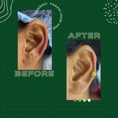 This before-and-after shows a standard earlobe repair procedure. Whether from trauma or long-term use of heavy earrings, I can surgically correct the split or stretched lobe to restore its original appearance.