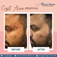 Cystic acne requires a professional approach. This before-and-after shows a significant reduction in inflammation and breakouts after a targeted treatment plan.