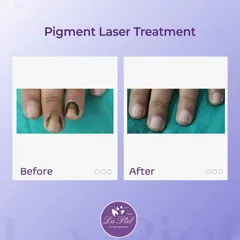 Pigmentation can also affect the nails, causing discoloration that can be concerning. This before-and-after shows the successful outcome of our pigment laser treatment on a nail, restoring its natural and healthy appearance.