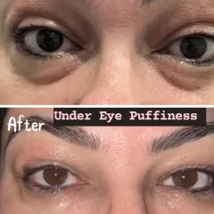 This before-and-after comparison demonstrates the effectiveness of our treatment for under-eye puffiness. The 'after' photo shows a significant reduction in bags and a smoother, more youthful eye area.