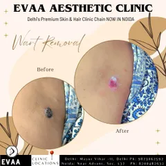 A before and after view of a wart removal procedure. Our advanced technology offers a painless and effective solution, with the treated area matching your skin color in 10-15 days.