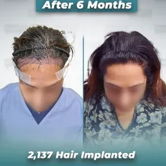 This image shows the client's head immediately after the procedure compared to the 6-month result. It provides a transparent look at the no-shave process and the incredible, confidence-restoring growth achieved.