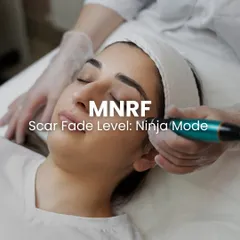 For clients looking for significant scar improvement with less downtime, I often recommend Microneedling RF, or MNRF. This procedure uses fine needles to deliver radiofrequency energy deep into the skin, triggering collagen production to repair scars from within. It is highly effective for various scar types and safe for Indian skin tones.