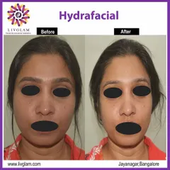 A clear example of the immediate results from a single Hydrafacial session. The client's skin appears visibly brighter, more hydrated, and smoother, demonstrating the effectiveness of this treatment for instant rejuvenation and glow.