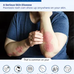 Psoriasis is more than just a rash; it's a serious skin disease that can appear on elbows, the scalp, and even nails. Understanding where it can show up is the first step toward seeking the immediate help needed to manage it effectively.