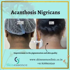 This result shows the successful treatment of Acanthosis Nigricans, often mistaken for dirt on the neck. By identifying the underlying cause and using a combination of topical medication and laser sessions, we significantly lightened the pigmentation and improved skin quality.