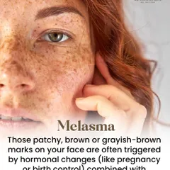 Melasma presents as patchy, brown, or grayish-brown marks on the face. It is a complex pigmentary disorder often triggered by a combination of hormonal changes, such as those during pregnancy, and sun exposure, which stimulates melanocytes.