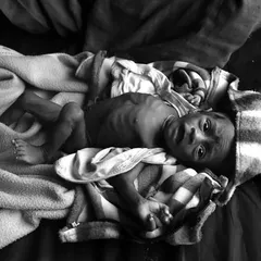 One of the most arresting photographs from the exhibition, showing the vulnerability of an infant affected by severe acute malnutrition. These images serve as a powerful call to action.