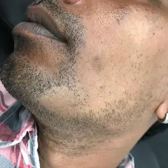 This is a clinical image showing Alopecia Areata on a client's beard area before treatment. This autoimmune condition causes the immune system to attack hair follicles, leading to patchy hair loss. We are experienced in diagnosing and treating this condition.