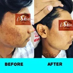 Here is a clear example of a successful transformation, showing the 'before' state with active acne and post-inflammatory hyperpigmentation, and the 'after' state with clearer skin. We create customized acne treatment plans to address both breakouts and resulting discoloration.