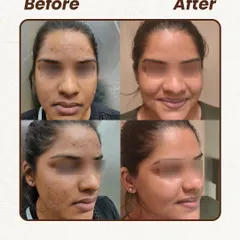 Here, the main concern was acne scarring and residual marks on the cheeks and forehead. Our plan focused on collagen-stimulating treatments to improve the texture and lift the scars, resulting in visibly smoother and healthier-looking skin.