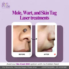 Our advanced laser treatments can safely and effectively remove moles, warts, and skin tags with precision. This before-and-after shows how we can help you achieve clear, smooth skin with minimal downtime.
