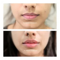 A subtle yet impactful lip enhancement using dermal fillers. The goal was to add natural-looking volume and definition, resulting in beautifully balanced and hydrated lips.