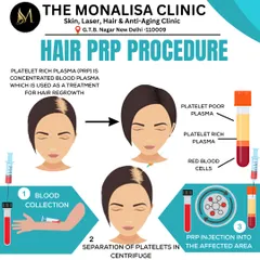 This visual guide breaks down the three simple steps of our Hair PRP procedure: blood collection, separation of plasma in a centrifuge, and injection into the scalp to stimulate hair regrowth.