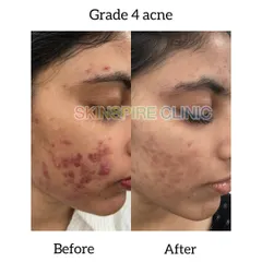 This is a case of Grade 4 acne, which involves deep, painful cysts. Our treatment significantly reduced the inflammation and number of lesions, providing much-needed relief and starting the journey toward scar revision.