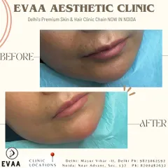 This before-and-after demonstrates the subtle yet significant impact of chin fillers. We enhanced the projection and shape of the chin, improving the overall facial profile and jawline definition non-surgically.